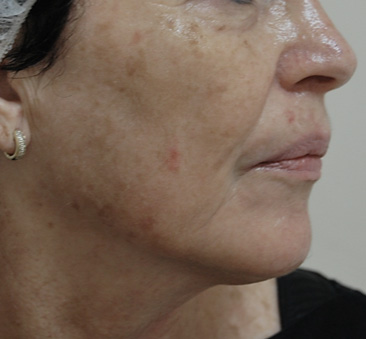 Skin Tightening