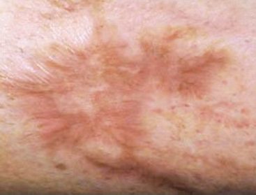 Fractional Laser Skin Resurfacing