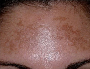 Fractional Laser Skin Resurfacing