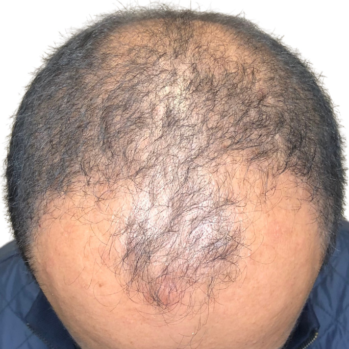 PRP Hair Restoration