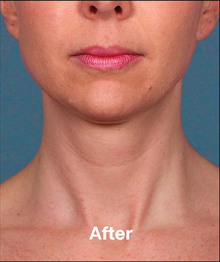 Kybella