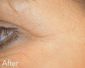 Dermal Fillers