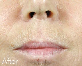 Dermal Fillers