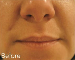 Dermal Fillers