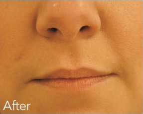 Dermal Fillers