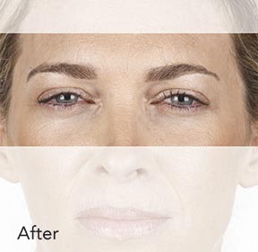 Botox & Wrinkle Relaxers