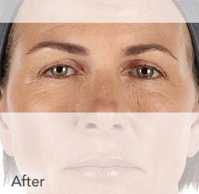 Botox & Wrinkle Relaxers