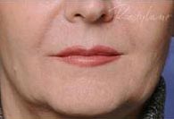 Dermal Fillers