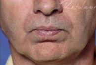 Dermal Fillers