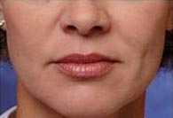 Dermal Fillers