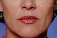 Dermal Fillers