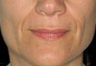 Dermal Fillers