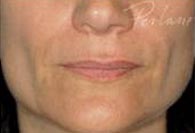 Dermal Fillers