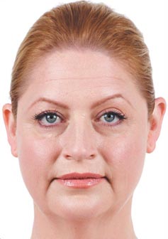 Dermal Fillers