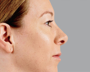 Dermal Fillers