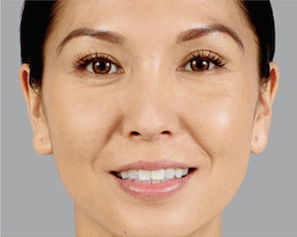 Dermal Fillers