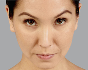 Dermal Fillers