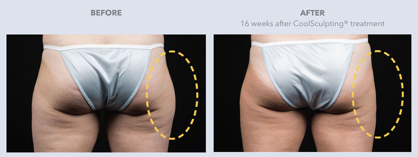 Coolsculpting patient before and after photo