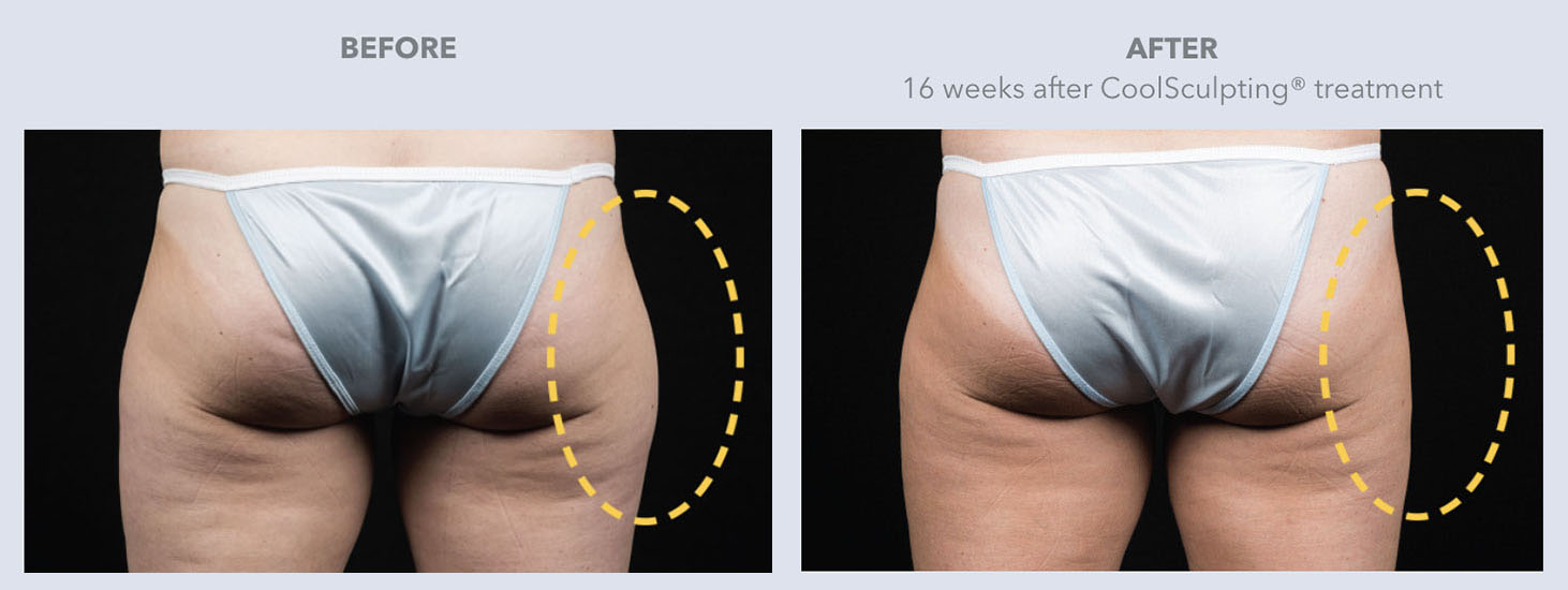 CoolSculpting Elite® Boston  Non-Surgical Fat Reduction Wellesley