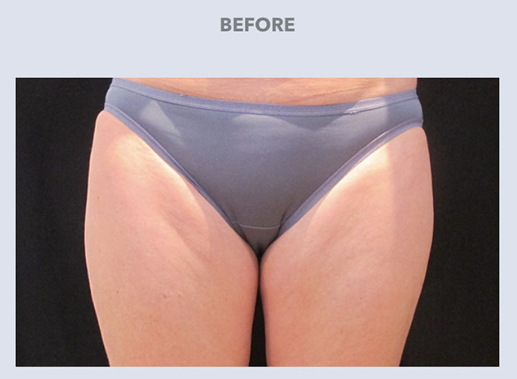 Coolsculpting