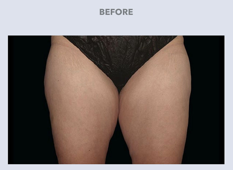 Coolsculpting