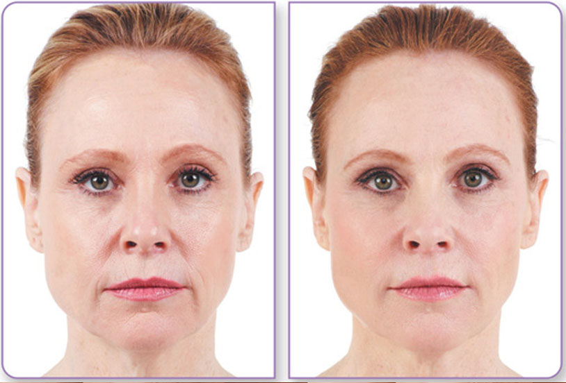 Dermal filler before and after patient photo