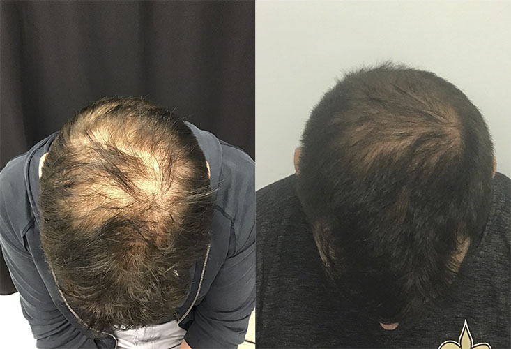 Real patient hair restoration before and after photo
