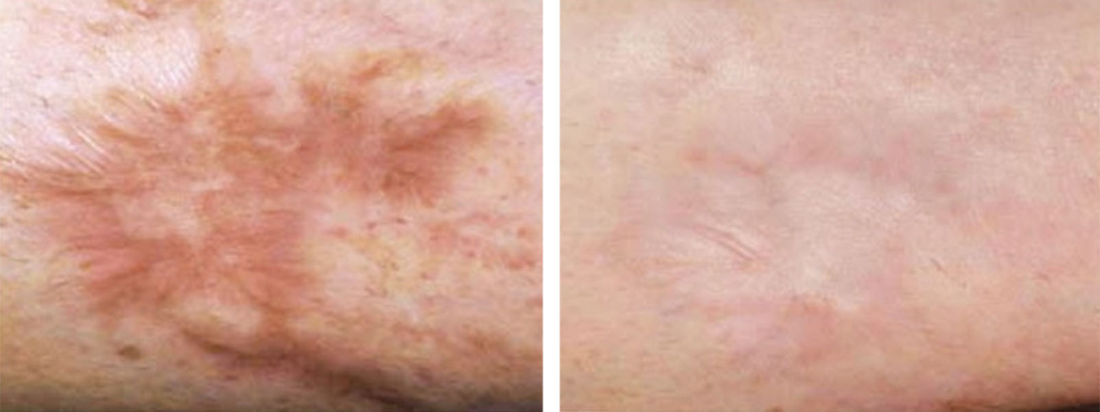 Laser Resurfacing patient before and after photo