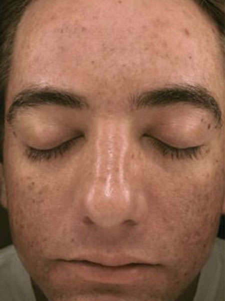 Microneedling