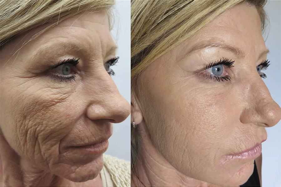 Real patient Microneedling before and after photo