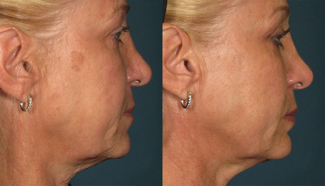 Ultherapy patient before and after photo