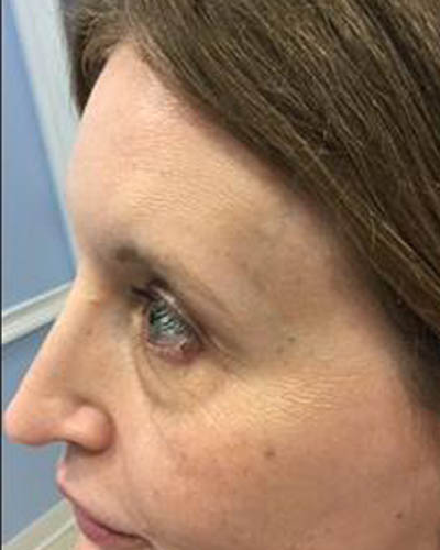 Eyelid Surgery