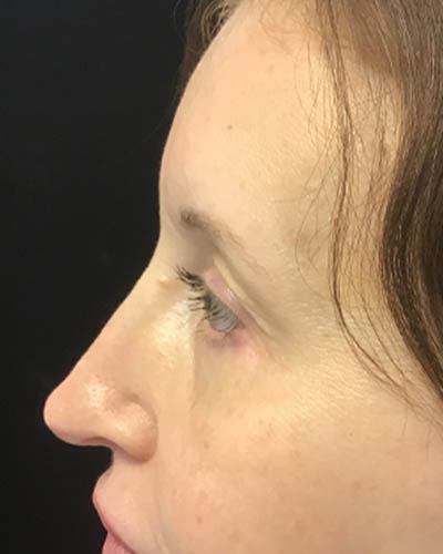 Eyelid Surgery