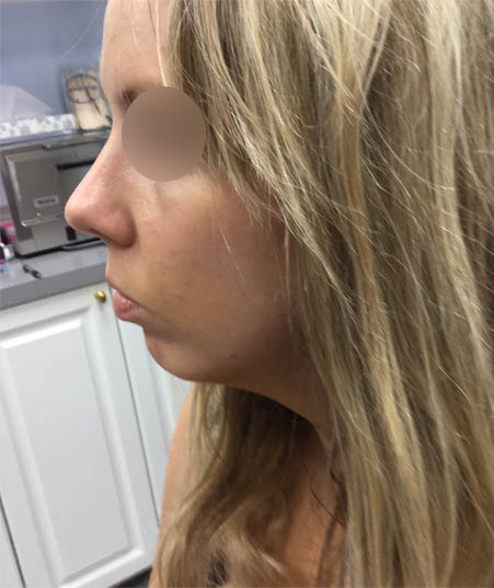 Kybella