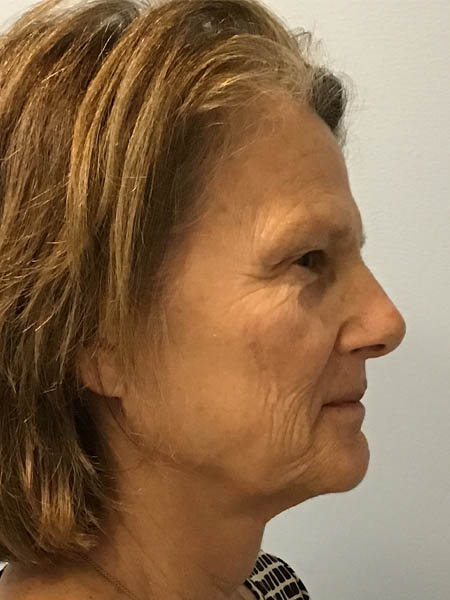 Microneedling