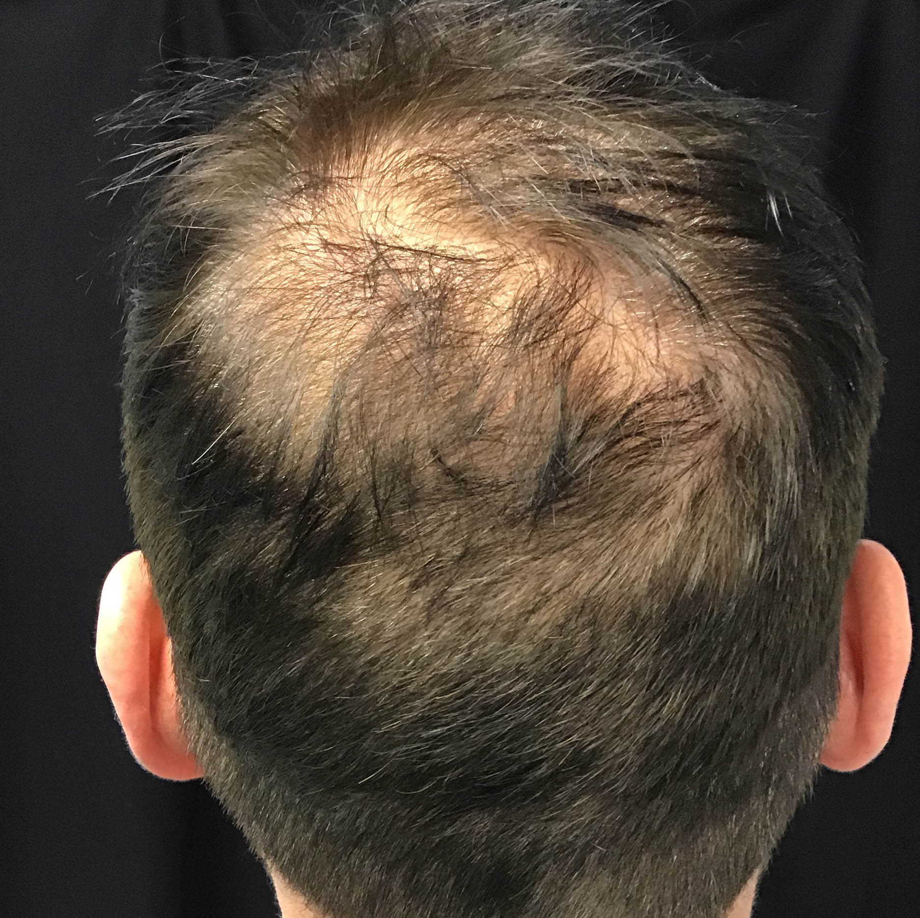 PRP Hair Restoration