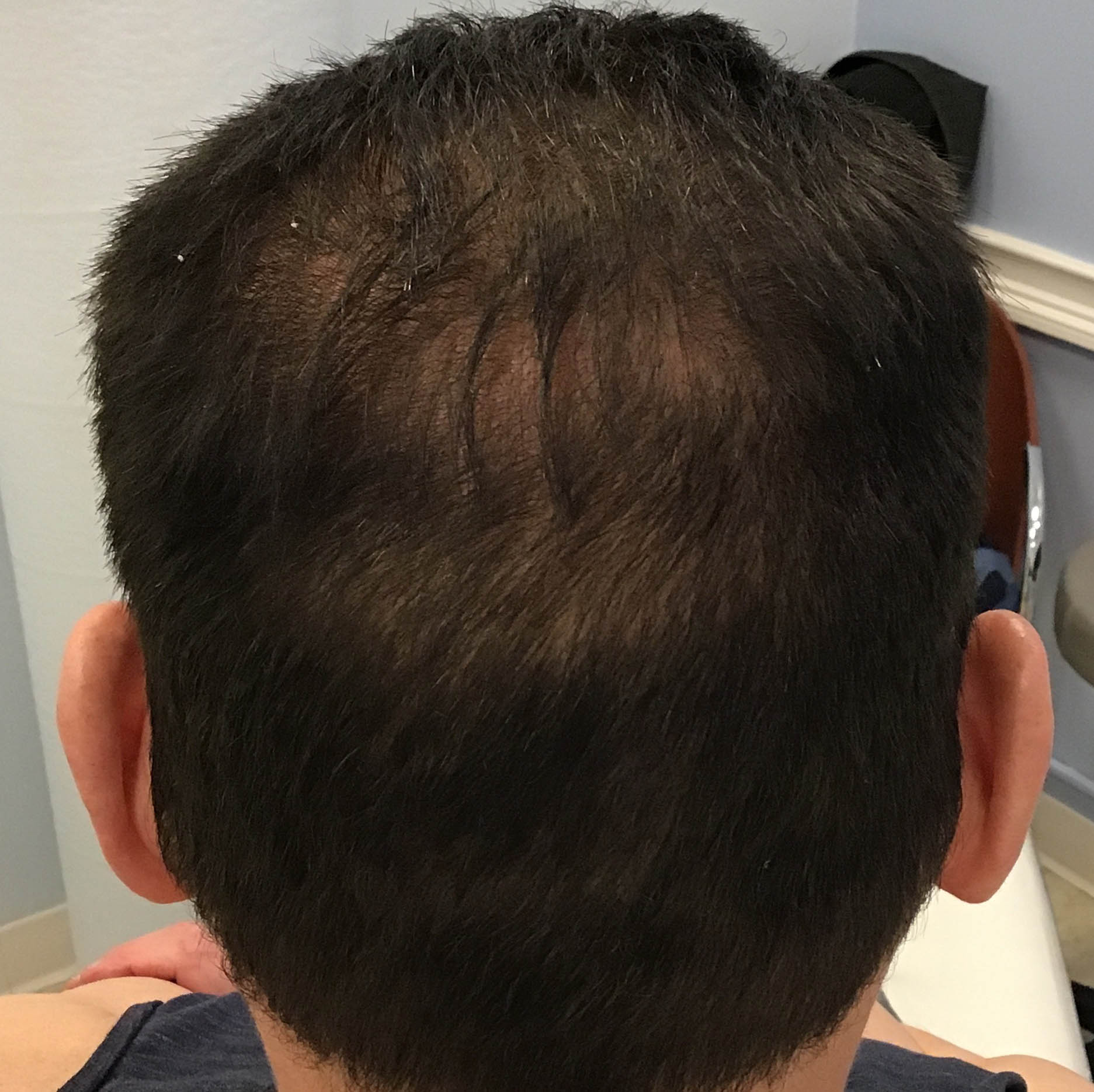 PRP Hair Restoration