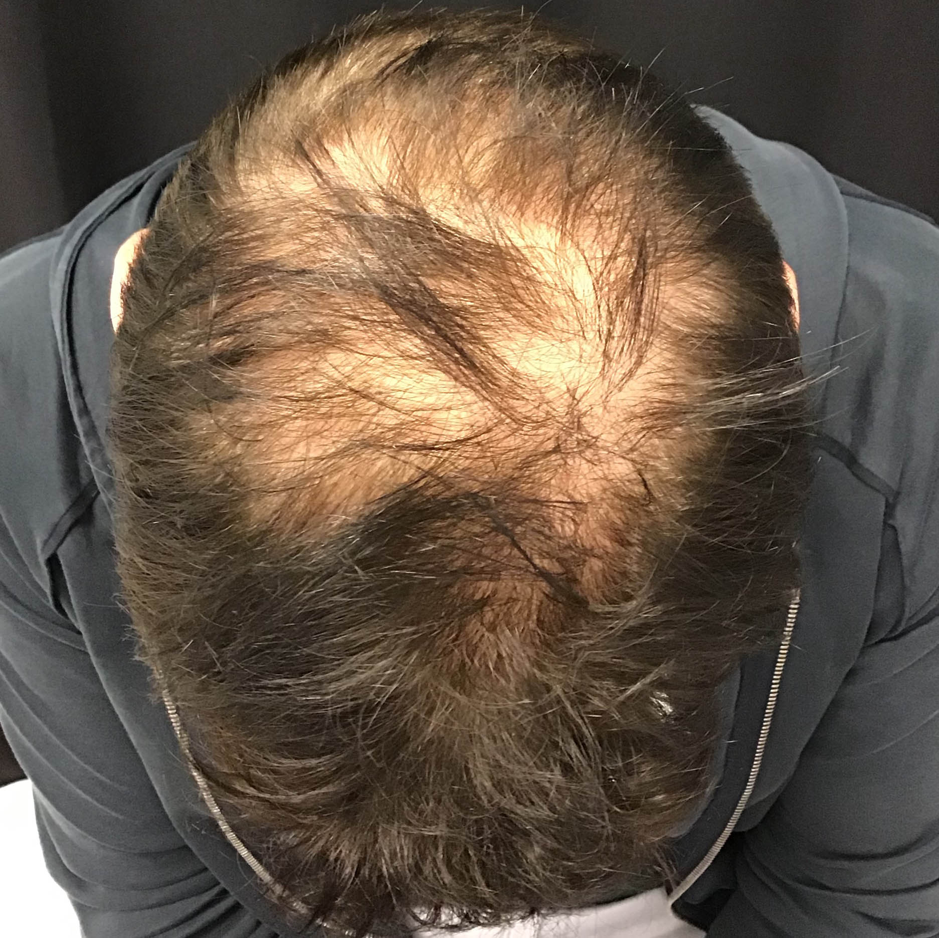 PRP Hair Restoration
