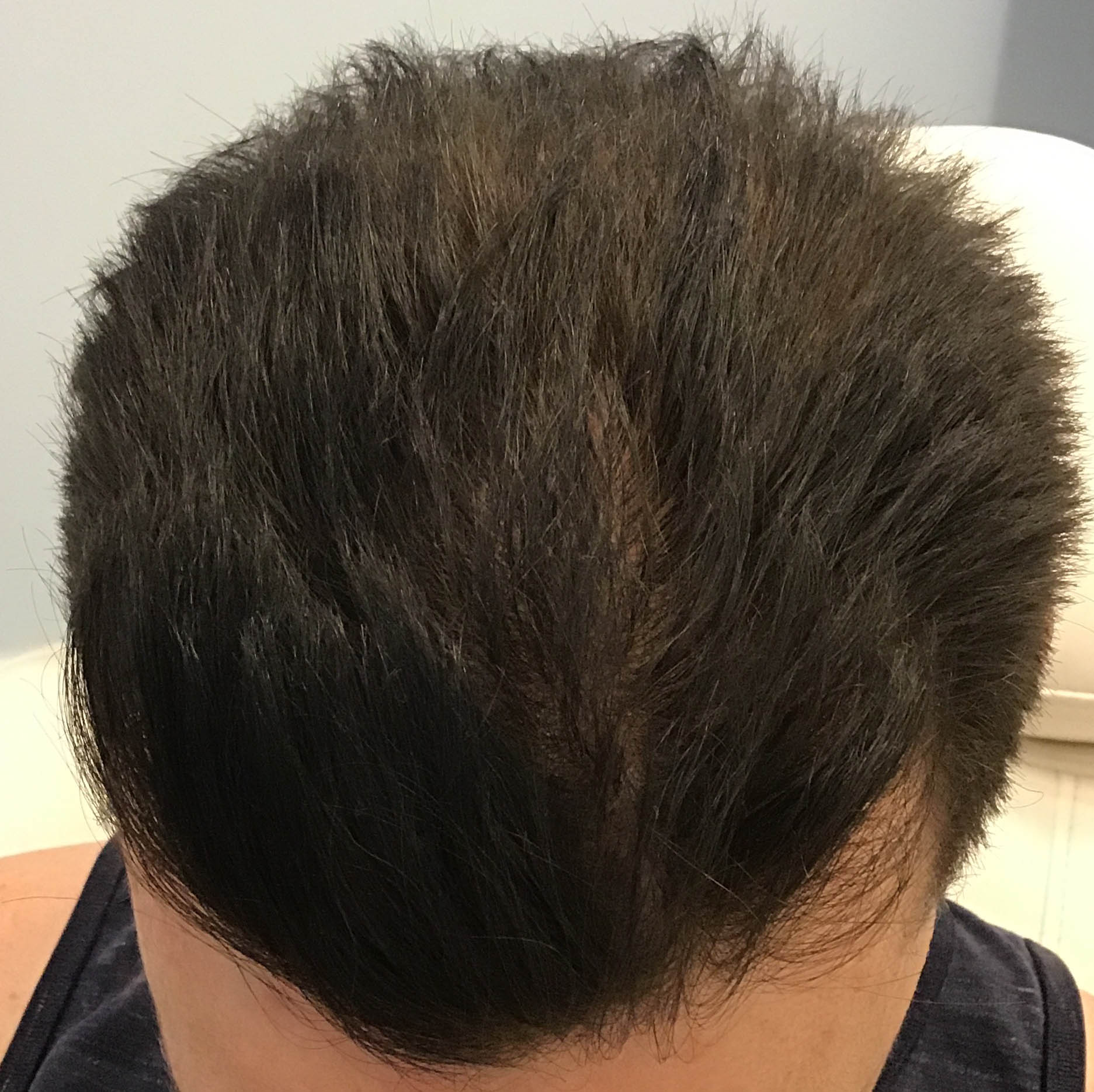 PRP Hair Restoration